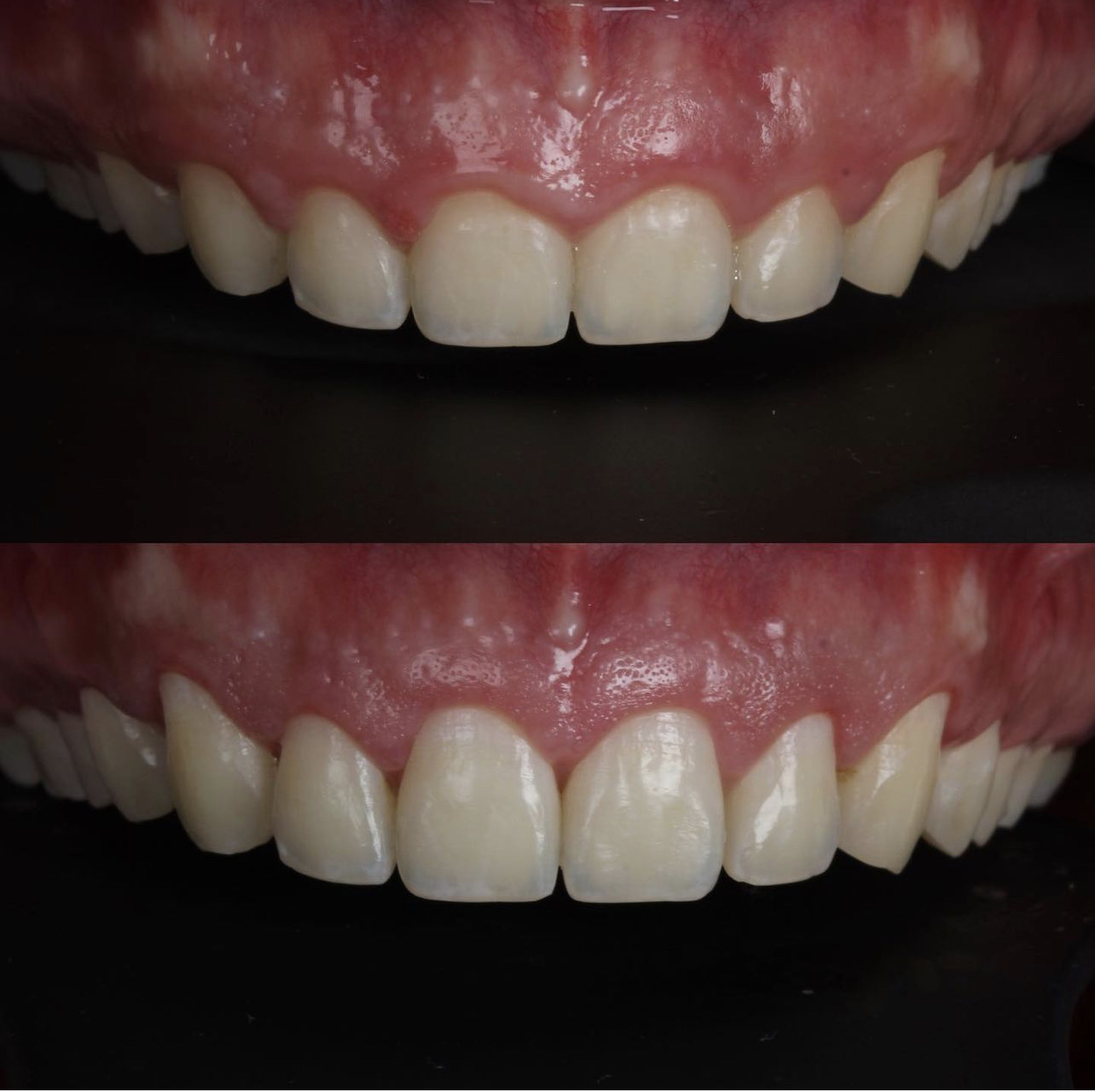 Gengivoplastia — detalhe do sorriso