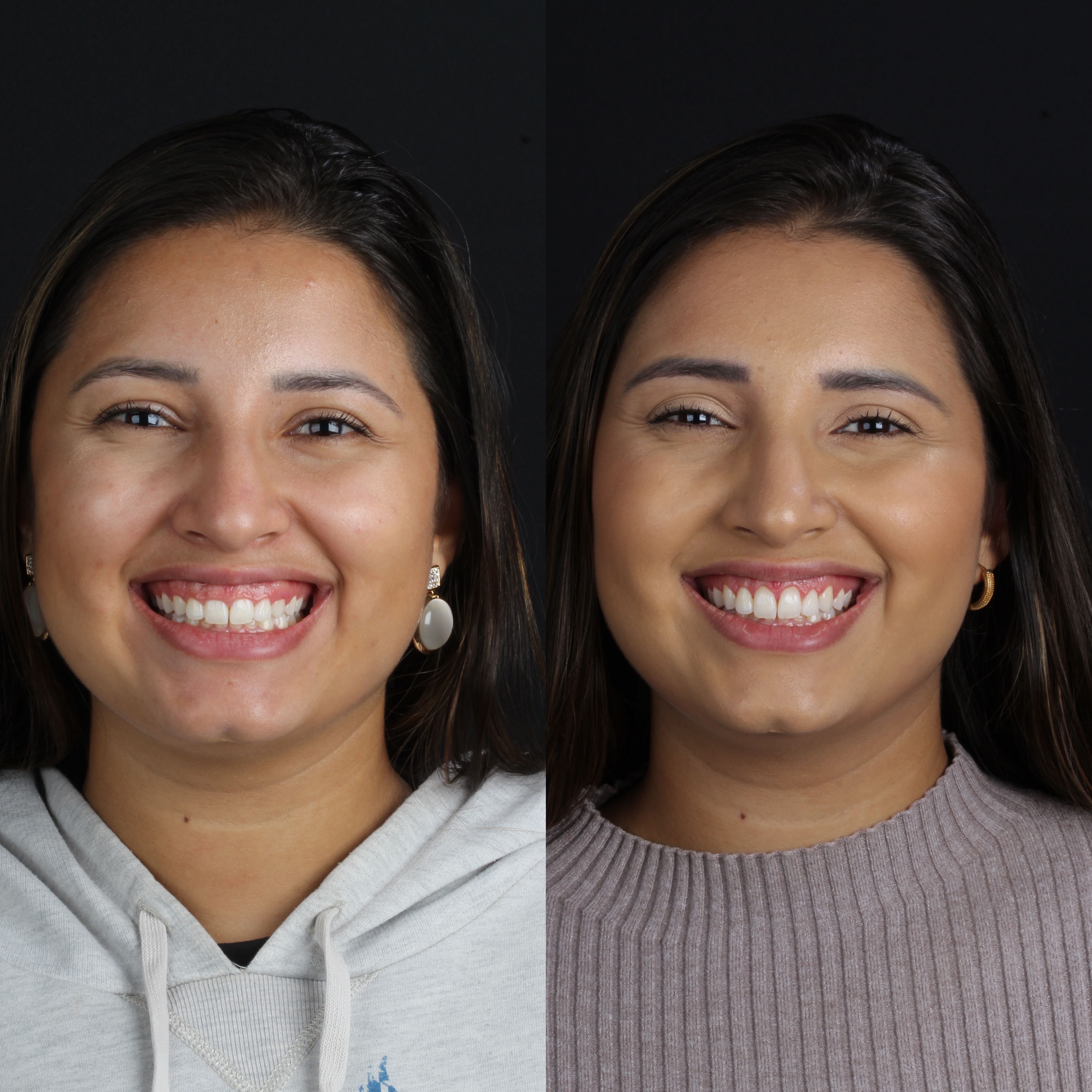 Gengivoplastia — comparação facial