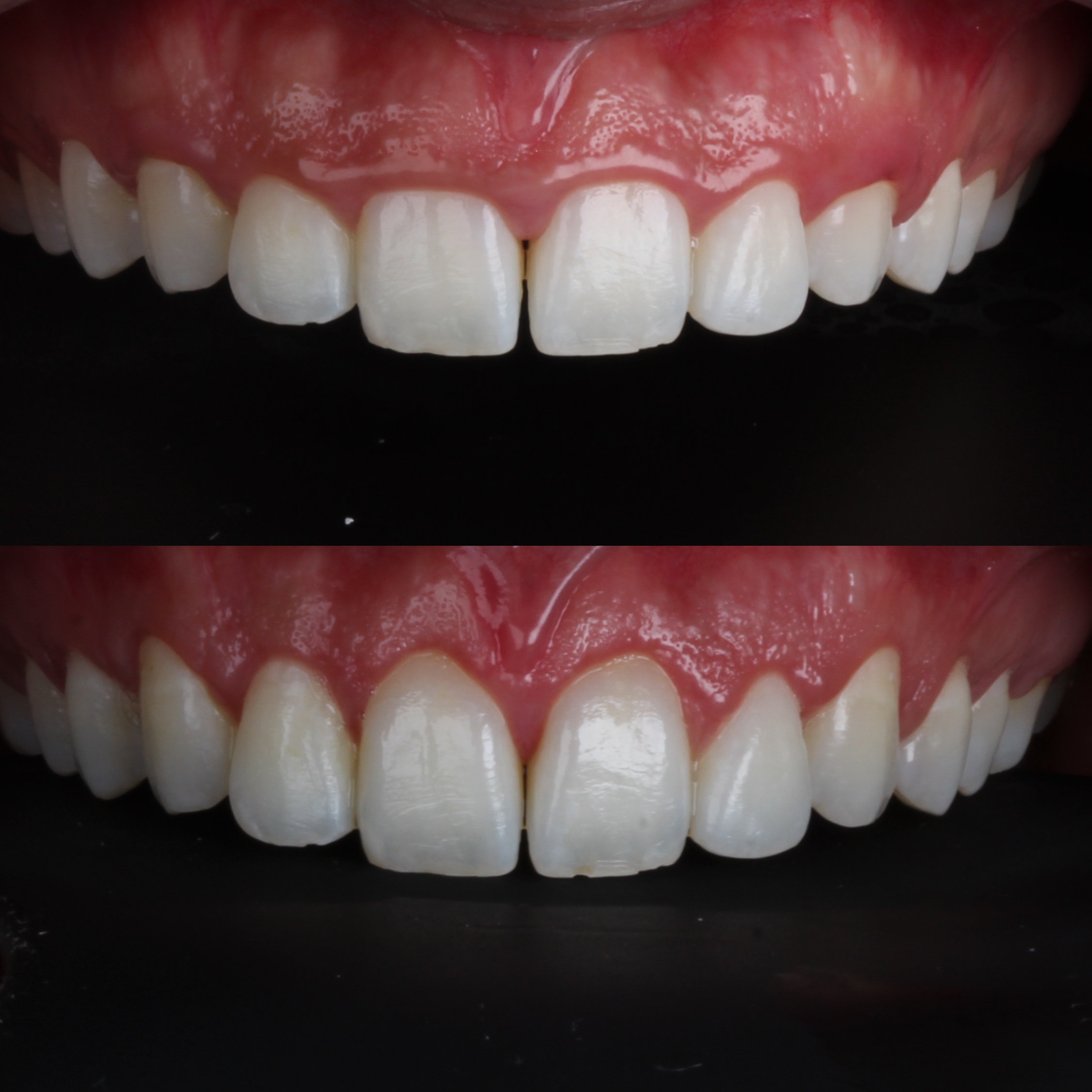 Gengivoplastia — detalhe do sorriso