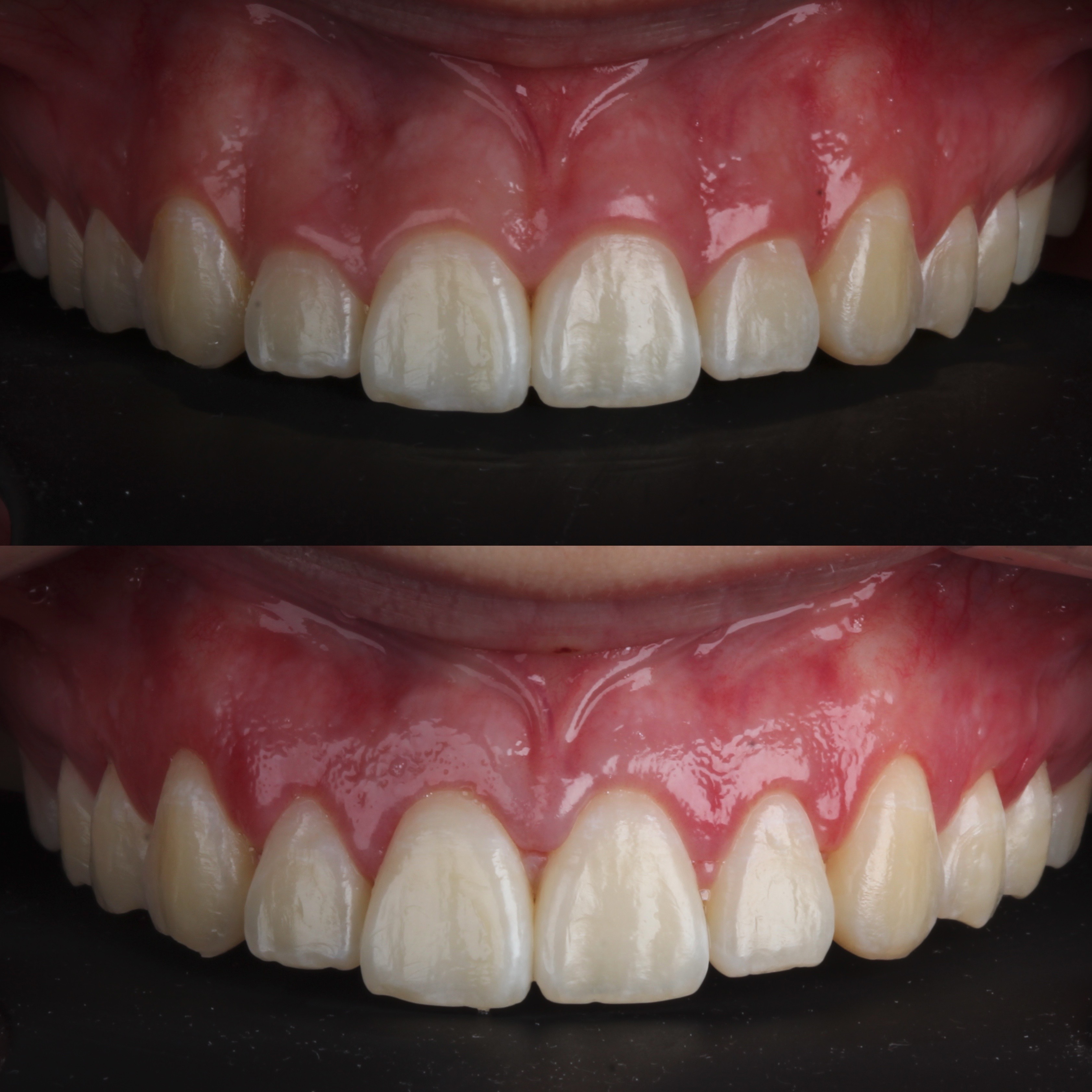 Gengivoplastia — detalhe do sorriso