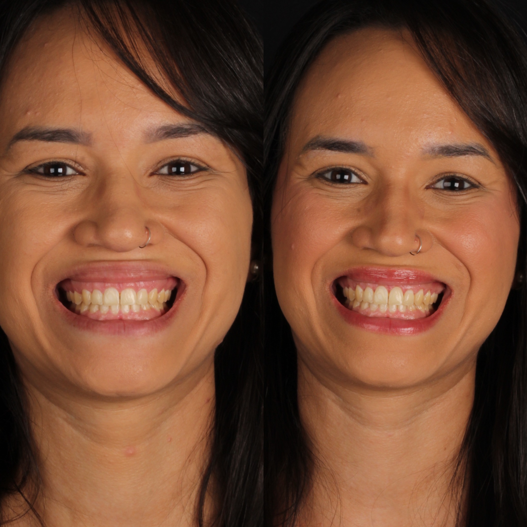 Gengivoplastia