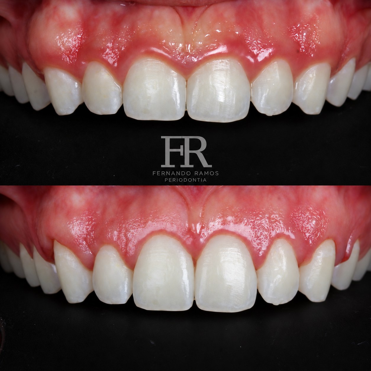 Sorriso gengival intraoral