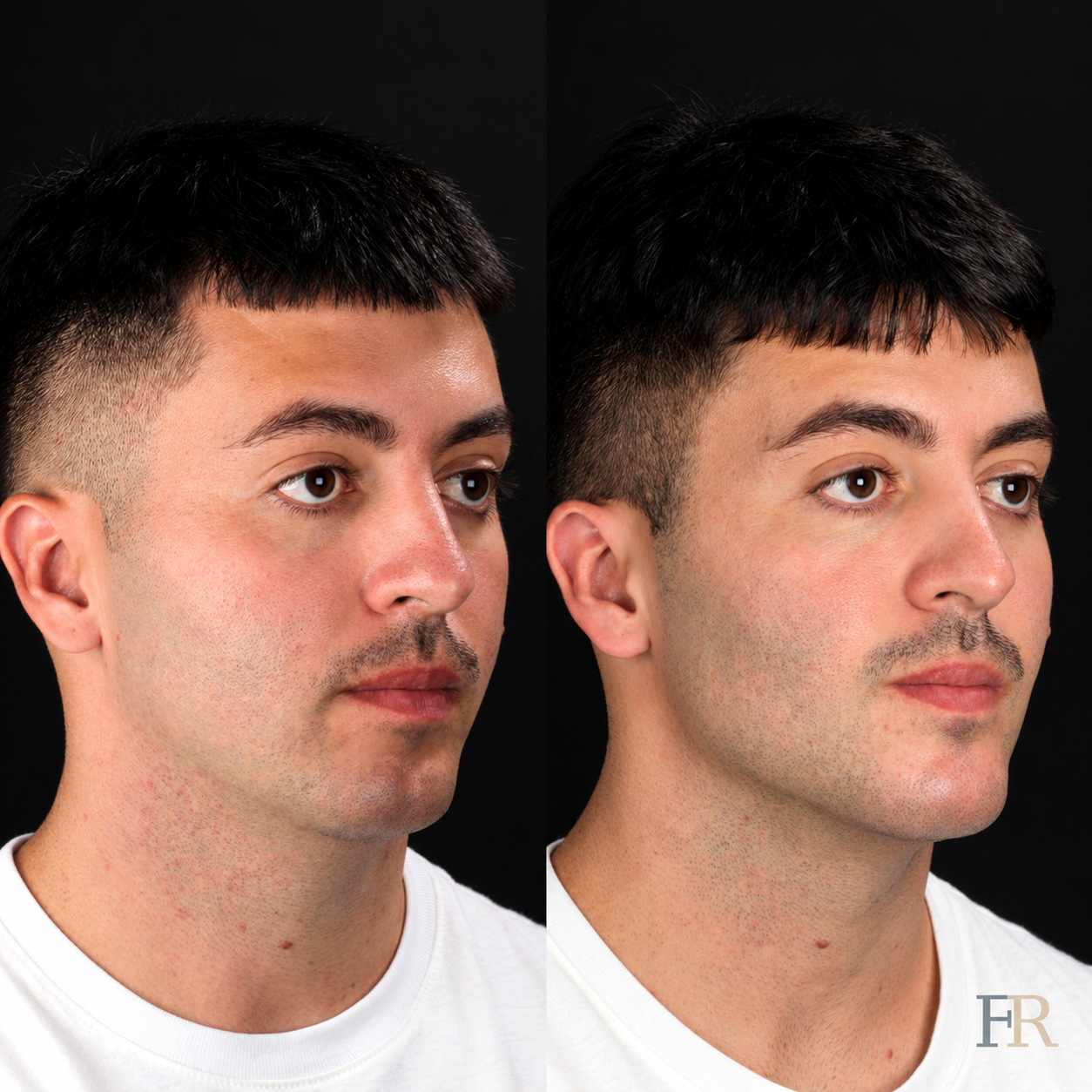 Prótese facial (mandíbula)